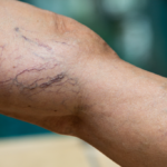 Jangan Anggap Remeh! Varises Bukan Sekadar Masalah Kosmetik